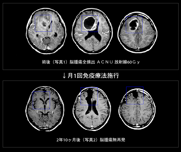 脳腫瘍 グリオブラストーマ 膠芽腫 症例1 免疫療法による癌 がん 治療 株式会社リンフォテック